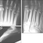 metatarsal bone fracture treatment
