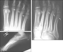 metatarsal bone fracture treatment