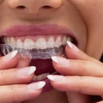 Invisalign Treatment