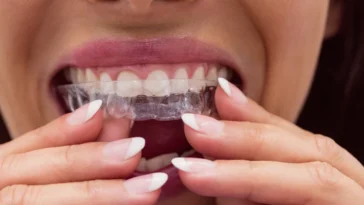 Invisalign Treatment