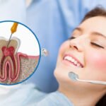 root-canal-cost-houston
